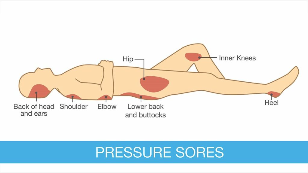 Common locations of pressure sores.